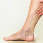 What Type of Physician Can Help with Varicose Vein Issues?