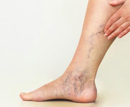 What Type of Physician Can Help with Varicose Vein Issues?