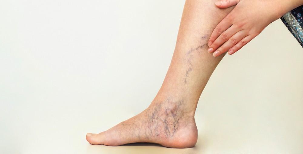 What Type of Physician Can Help with Varicose Vein Issues?